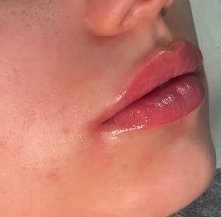 Aumento de labios